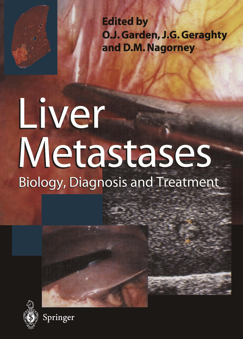 Liver Metastases